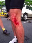 Injured_biker__s_leg_footprint.jpg